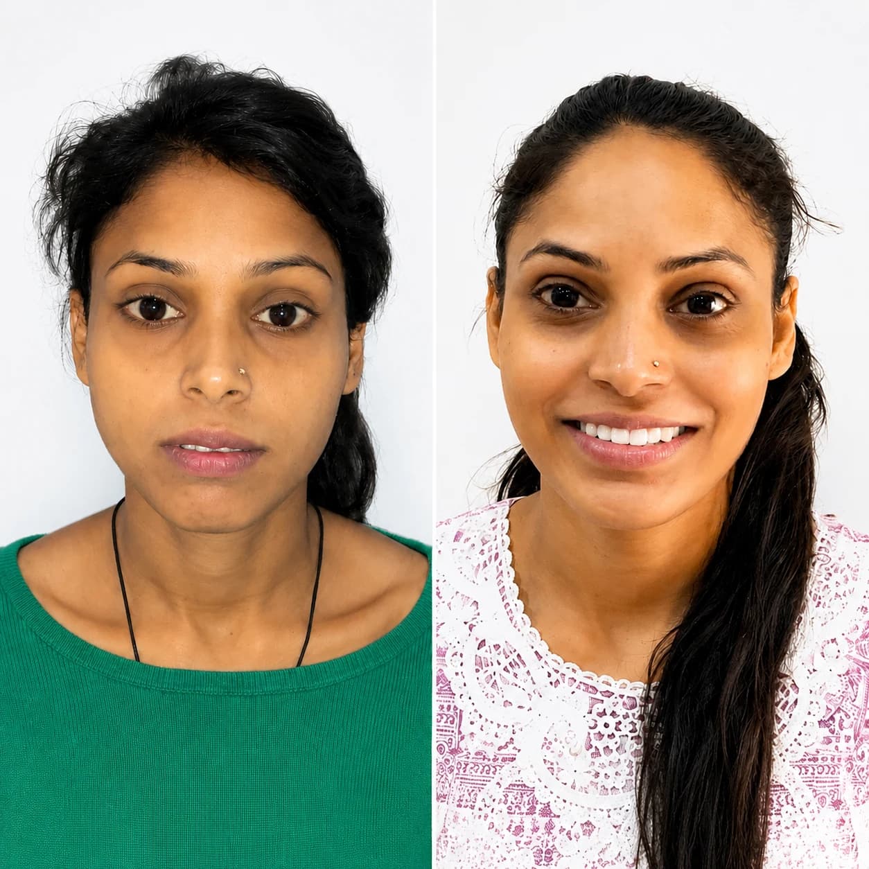 Before and after adult orthodontic alignment result