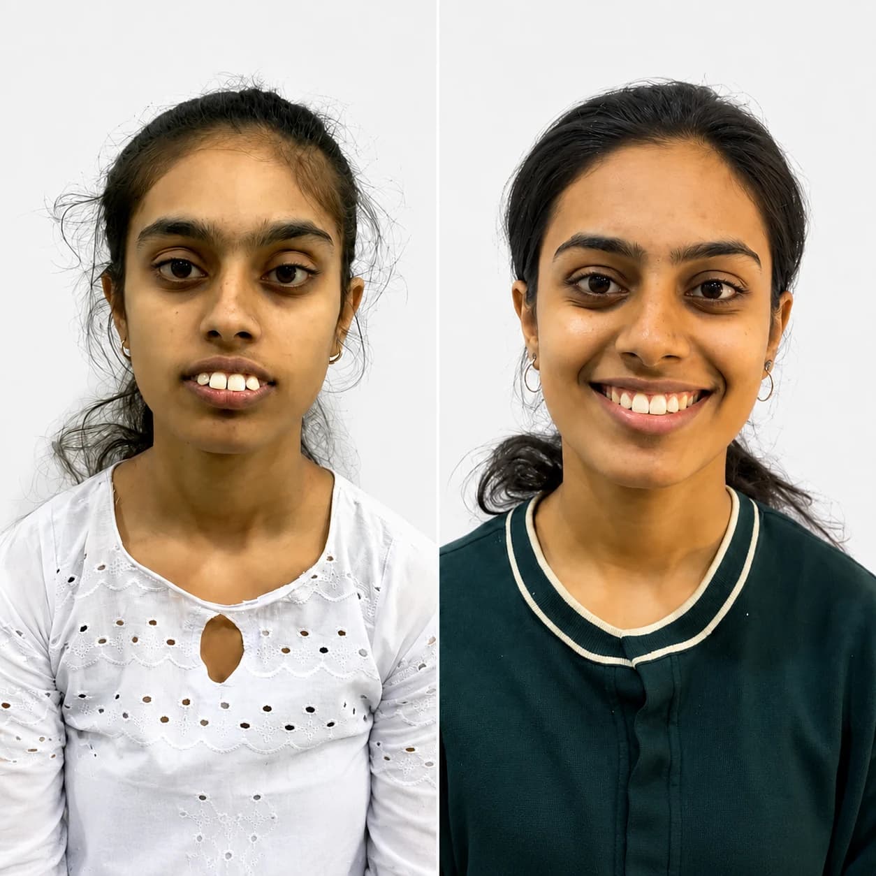 Before and after orthodontic alignment result