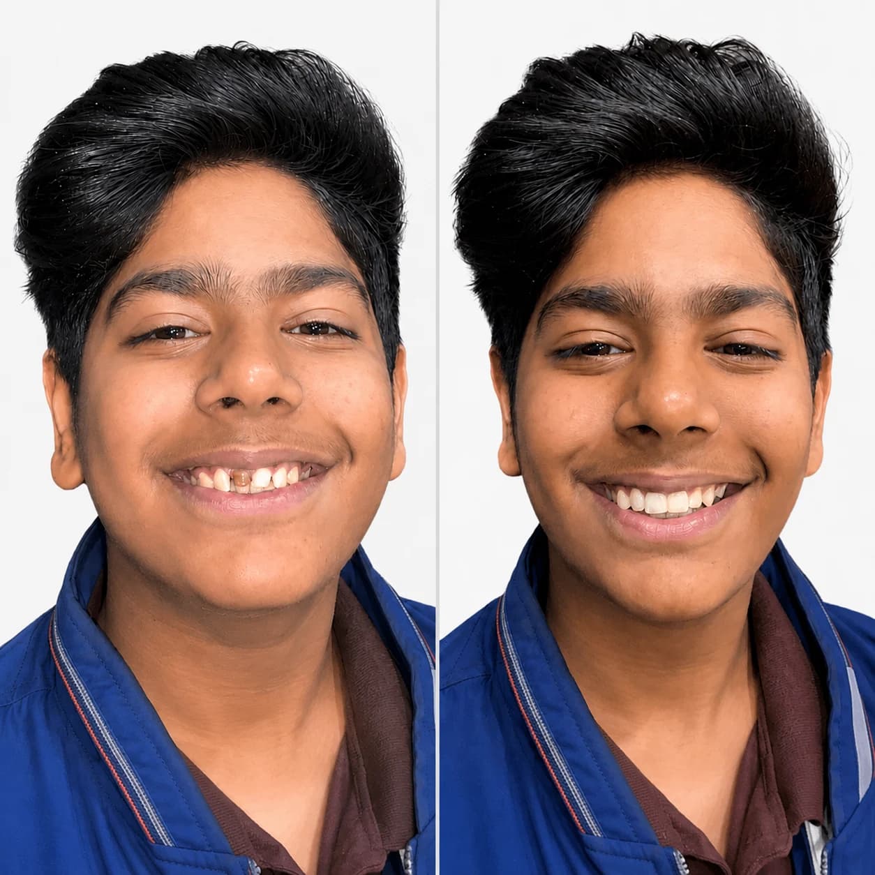 Before and after orthodontic smile correction result