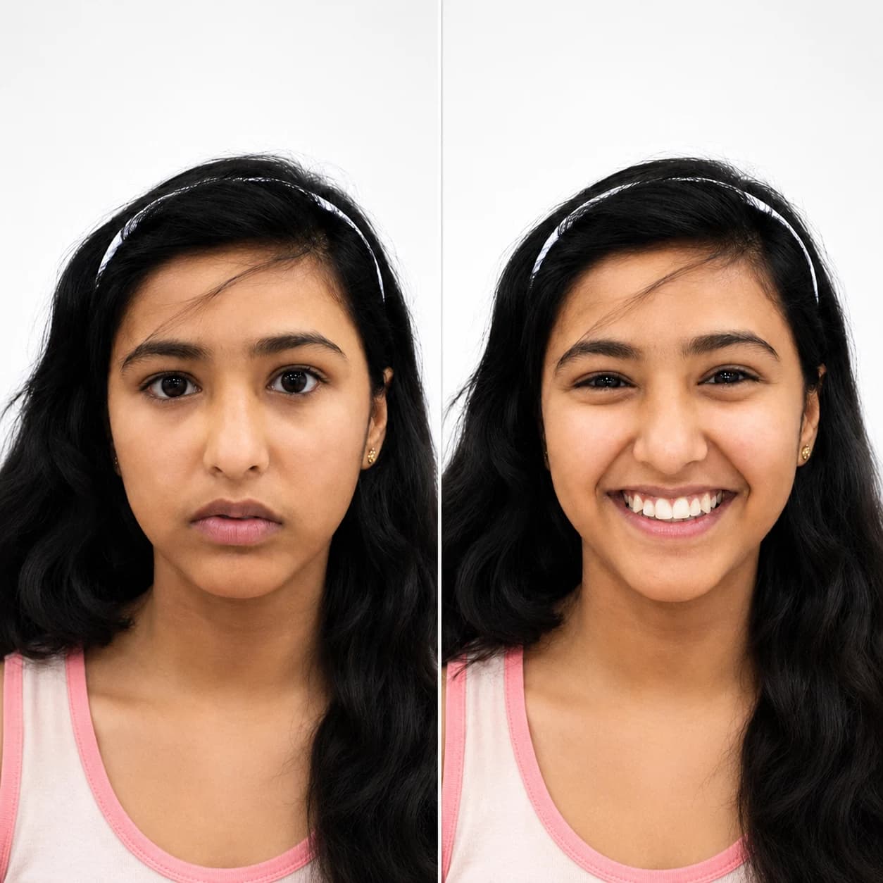 Before and after young patient smile result